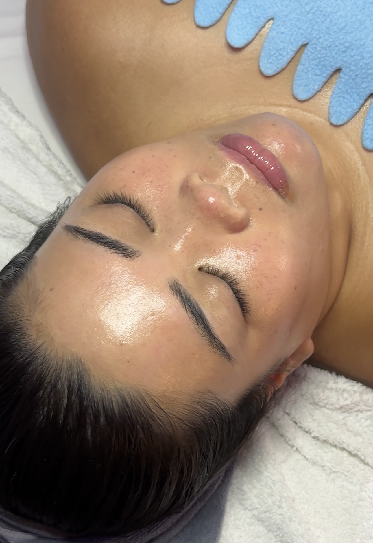Enhanced Aesthetics treatment result