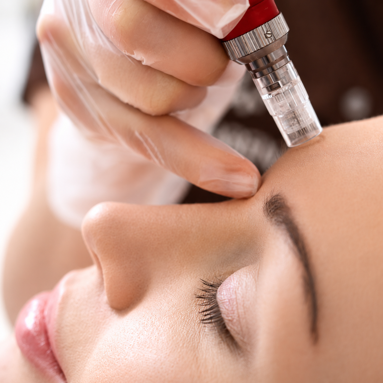 Microneedling treatment